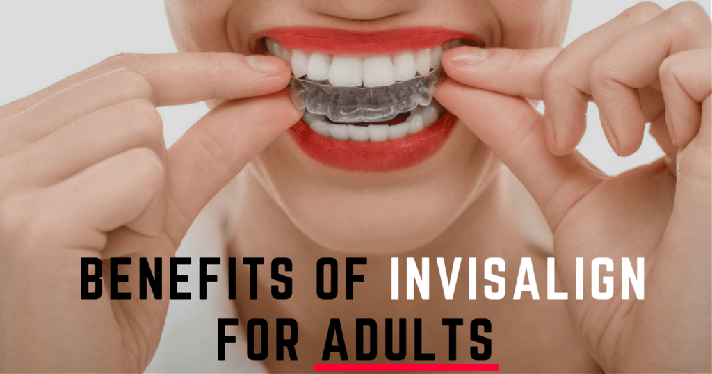 Benefits of Invisalign Treatment for Adults in OKC - Pragma Dental OKC